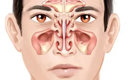 Cẩn trọng: nguy cơ mù mắt vì viêm xoang mạn tính khi đã bị tiểu đường