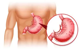 Nếu mắc những triệu chứng này, hãy nghĩ ngay đến bệnh dạ dày