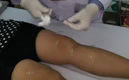 Cấy chỉ điều trị bệnh gút