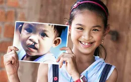 TP.HCM: Phẫu thuật miễn phí cho người bị dị tật khe hở môi, hàm ếch