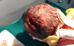 Mẹ chồng dùng dao rạch tầng sinh môn đỡ đẻ, thai nhi bị rách đầu