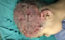 Đi uốn tóc, thiếu nữ bị bỏng sâu vùng đầu