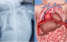 Hơn 10 trẻ sơ sinh thoát vị hoành bẩm sinh được phẫu thuật nội soi thành công