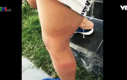 Lại thêm vụ bạo hành trẻ mầm non