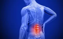 Chủ quan đau, mỏi cổ tá hỏa phát hiện bị viêm cột sống dính khớp thể trục