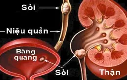 Tán sỏi nội soi tiết niệu bằng laser ngược dòng