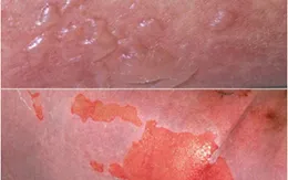 Sử dụng thuốc nam không rõ nguồn gốc, bệnh nhân nguy kịch