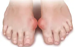 Bệnh gout: yếu tố nguy cơ - cách phòng ngừa