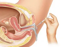 Sau khi bơm tinh trùng cần tránh những việc này