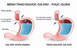 Cẩn trọng: Đồ uống có cồn gây bệnh trào ngược dạ dày - thực quản