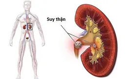 Nguyên nhân người bệnh đái tháo đường dễ mắc bệnh thận