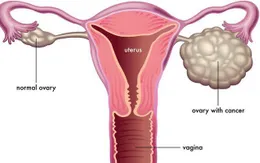 Nguyên nhân và triệu chứng bệnh ung thư buồng trứng