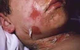 Bé trai nhiễm vi khuẩn tụ cầu vàng nguy hiểm sau chấn thương do ngã xe đạp