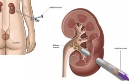 Không muốn mắc sỏi thận, bạn chớ quên 3 điều đơn giản này mỗi ngày