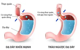 8 dấu hiệu cảnh báo bệnh viêm thực quản trào ngược