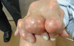 "Cục tophi” - Người mắc bệnh gout cần cẩn trọng với nguy cơ hoại tử