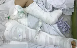 Ngã từ lầu 3, bé gái chấn thương nặng
