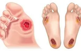 Chăm sóc bàn chân ở bệnh nhân đái tháo đường