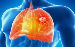 Điểm mặt các "thủ phạm" gây ung thư phổi