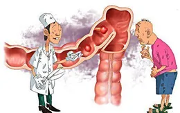 Cảnh báo: Hơn 20% dân số Việt Nam mắc bệnh viêm đại tràng
