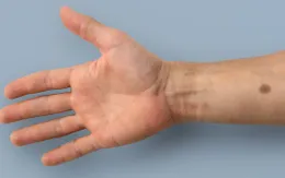 Phát hiện ung thư nhờ máy cảm ứng đo sự phát triển của nốt ruồi