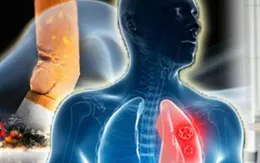 Cảnh báo: Tỷ lệ mắc mới ung thư ở nam giới gia tăng nhanh