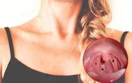 Có thói quen này bạn dễ mắc ung thư thanh quản