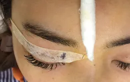 Cảnh báo: Tân trang mắt nữ bệnh nhân bị kim khâu rơi vào mắt