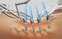 Vít cố định xương tự tiêu trong cơ thể