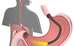 Nội soi gây mê cần chuẩn bị những gì?