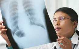 Chẩn đoán sớm ung thư phổi