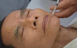 Tiêm Botulinum toxine điều trị co thắt mí mắt và co thắt nửa mặt