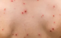 Đắk Lắk: Ghi nhận 2 ổ dịch thủy đậu tại huyện Lắk và TP. Buôn Ma Thuột