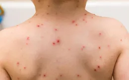 Thủy đậu đang gia tăng, bảo vệ bé thế nào?