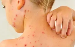 Điều trị thủy đậu an toàn ở trẻ em
