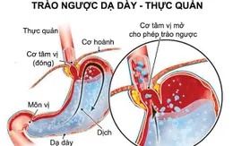 Thay đổi lối sống giúp phòng bệnh trào ngược dạ dày thực quản