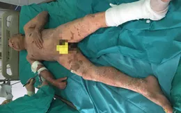 Tổn thương 90% da khi dùng thuốc nam điều trị u phì đại tuyến tiền liệt