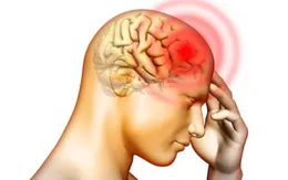 Dị dạng mạch máu não làm tăng tỷ lệ đột quỵ ở người trẻ tuổi