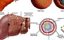 Gần 70% ca ung thư gan có nhiễm virus viêm gan B