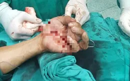 Bị đứt lìa bàn tay do cưa cắt