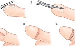 Những quan niệm sai lầm về bao quy đầu