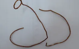 Bệnh nhân có sonde JJ cứng như kim loại