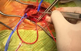 Phẫu thuật cho bệnh nhân bị hẹp động mạch cảnh