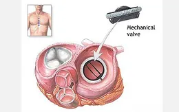 Van tim cơ học an toàn hơn van sinh học khi cấy ghép cho người trẻ