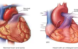 Hội chứng nguy hiểm Marfan – mối đe dọa cho tim và máu