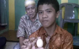 Ly kỳ câu chuyện cậu bé người Indonesia "đẻ" trứng trong hai năm
