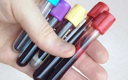 Xét nghiệm máu tại các bữa tiệc – xu hướng chăm sóc sức khoẻ kiểu mới
