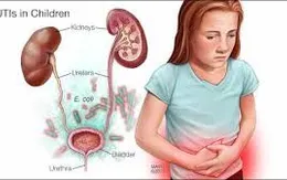 Viêm đường tiết niệu ở trẻ em