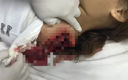 Ngã vào cưa máy, bé gái bị cắt lìa cánh tay