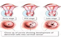 Hà Nội: Tổ chức khám tầm soát ung thư cho nữ công nhân lao động